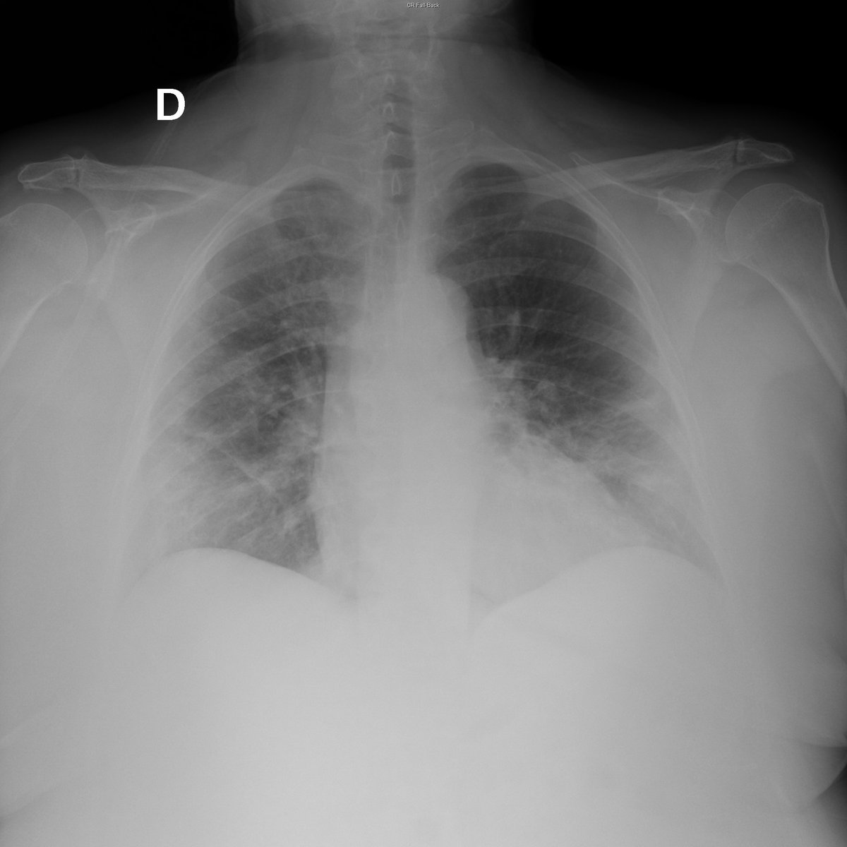 Case 25. 63yo female. Cough and fever. Day 1 and 4.