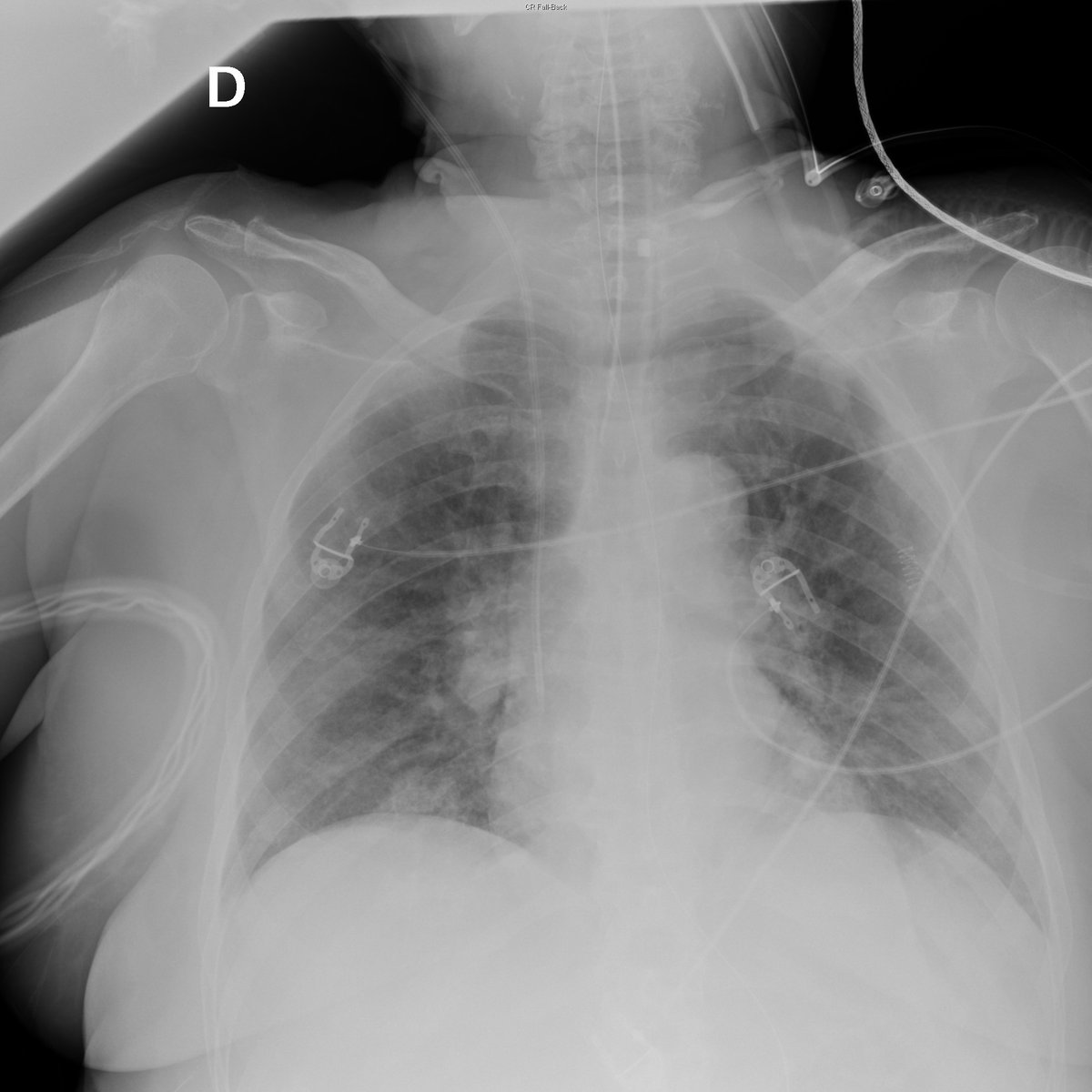 Case 27. 76yo female. Cough, dyspnea and fever. Day 1, day 1 (later same day), 3 and 6.