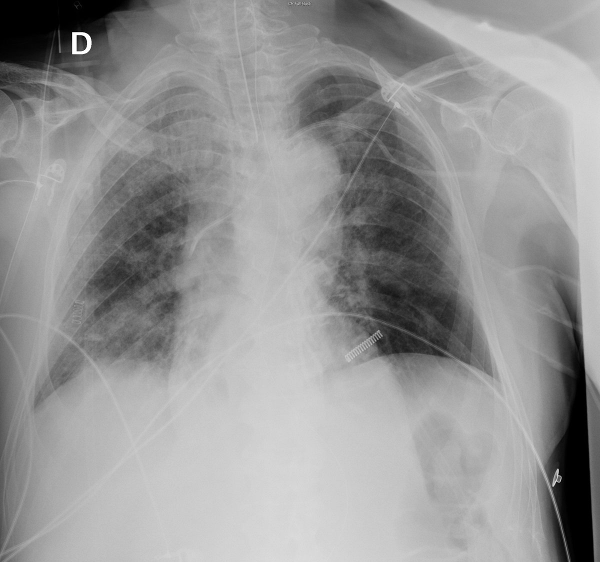 Case 30. 77yo male. Dyspnea. Day 1 (PA-L), 2 and 4.