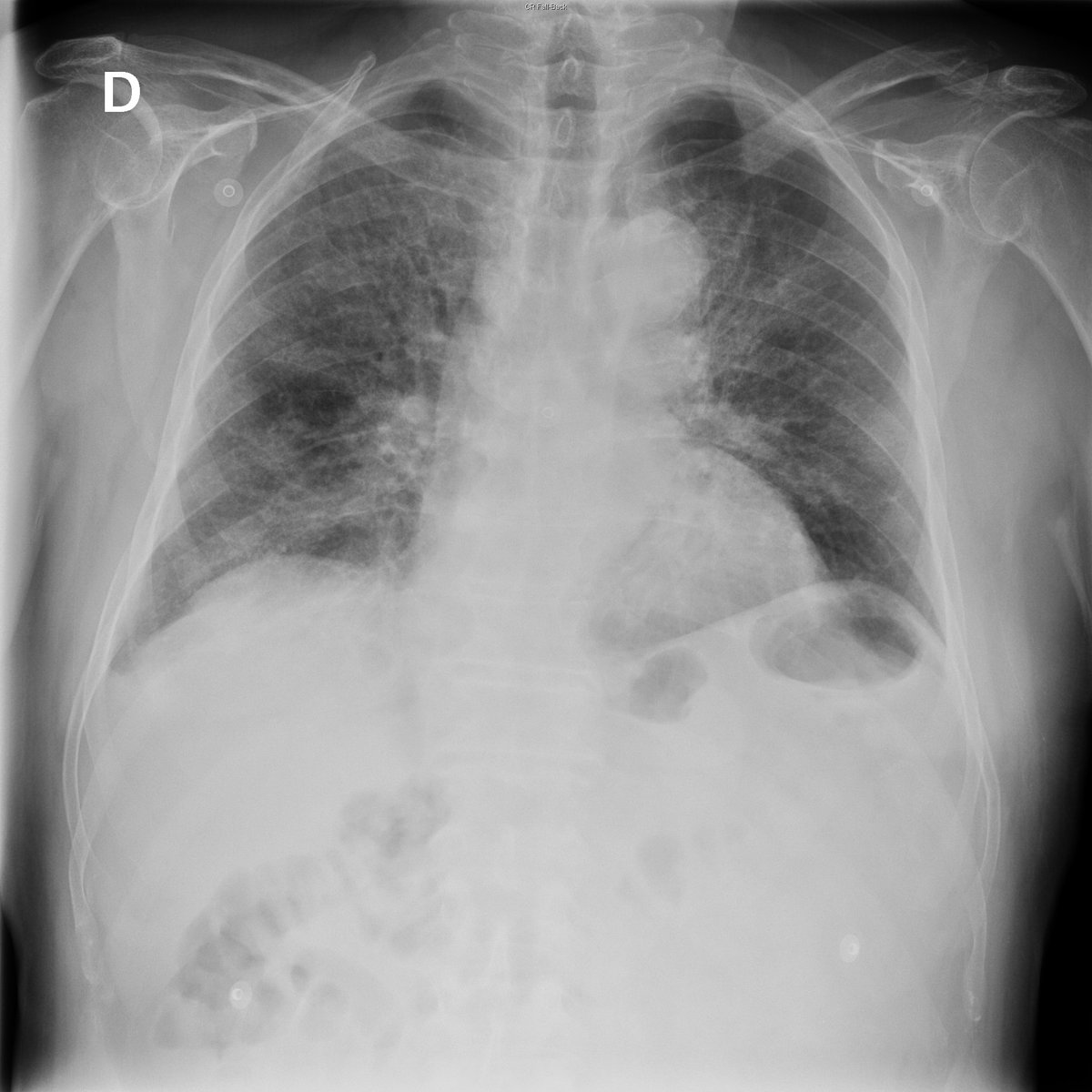 Case 30. 77yo male. Dyspnea. Day 1 (PA-L), 2 and 4.