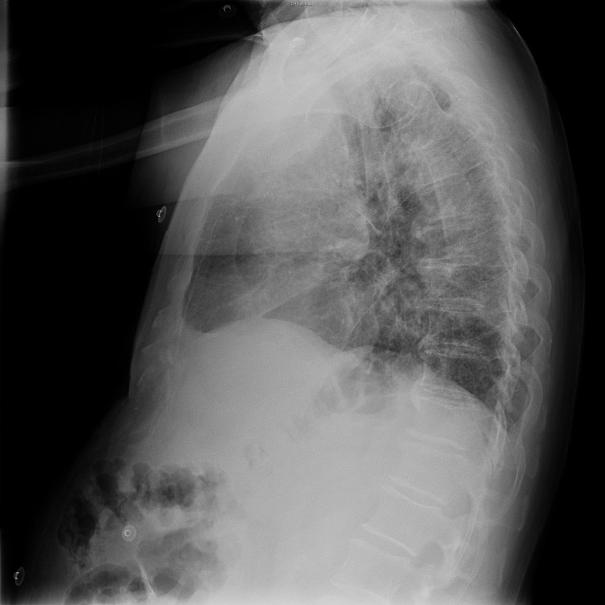 Case 30. 77yo male. Dyspnea. Day 1 (PA-L), 2 and 4.