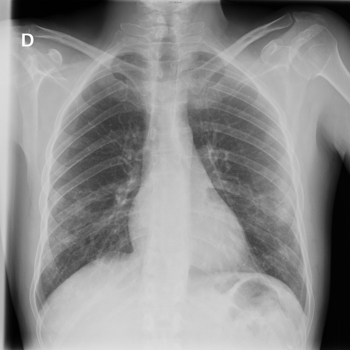 Case 29. 41yo male. Cough and fever. Day 1 (PA-L), 2 and 4.