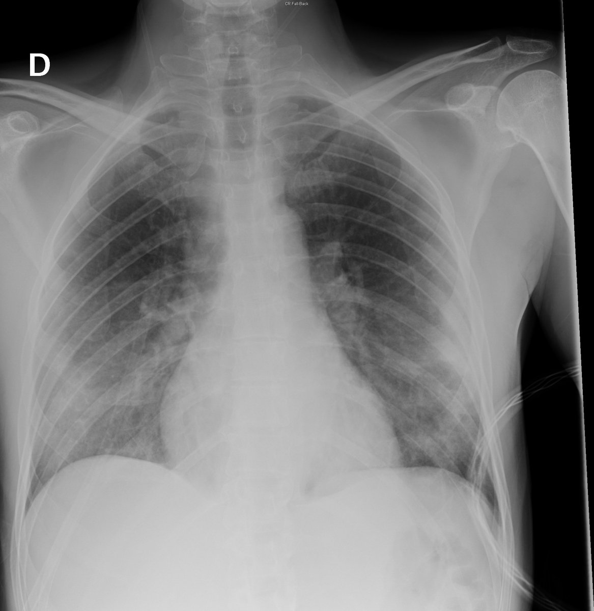 Case 29. 41yo male. Cough and fever. Day 1 (PA-L), 2 and 4.