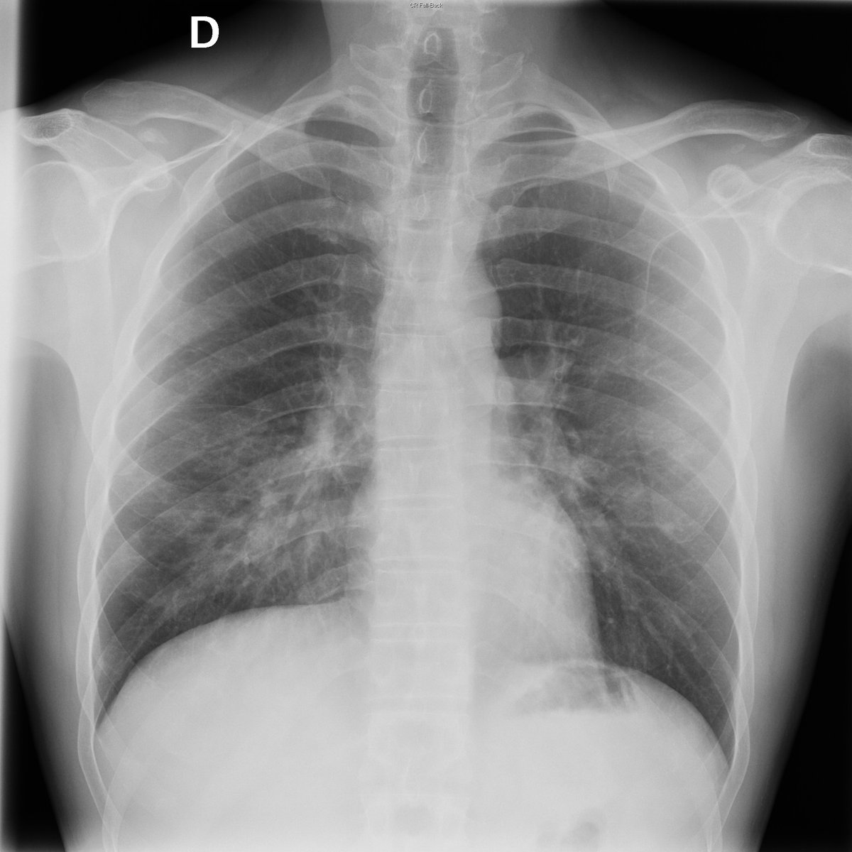 Case 35. 43yo male.