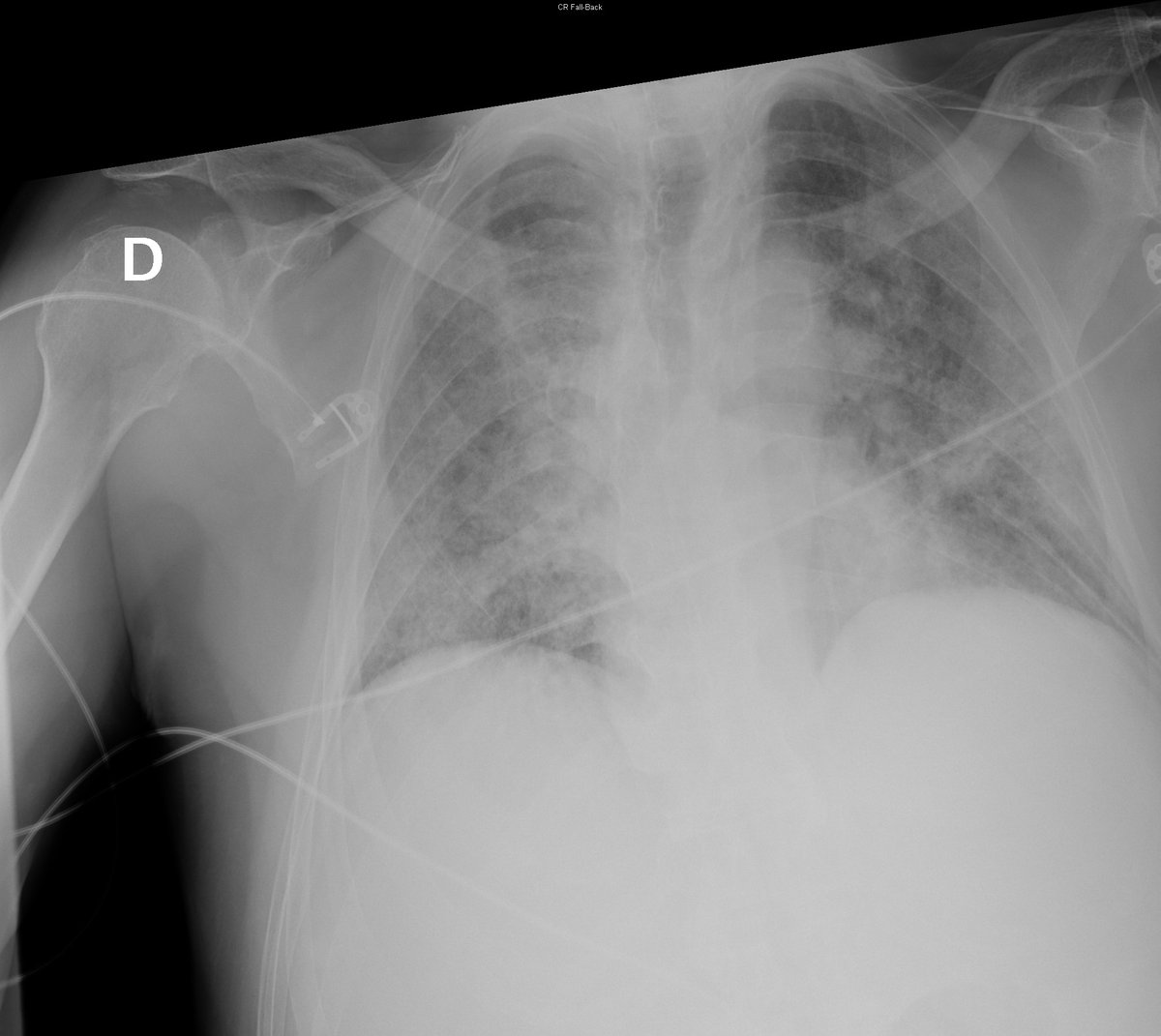 Case 40. 76yo male. Dyspnea, cough and fever. Day 1, 2, 3 and 5.