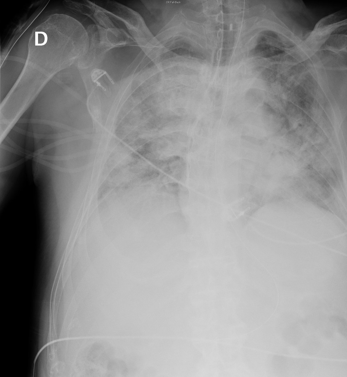 Case 40. 76yo male. Dyspnea, cough and fever. Day 1, 2, 3 and 5.