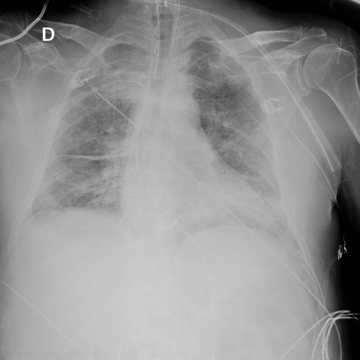 Case 40. 76yo male. Dyspnea, cough and fever. Day 1, 2, 3 and 5.