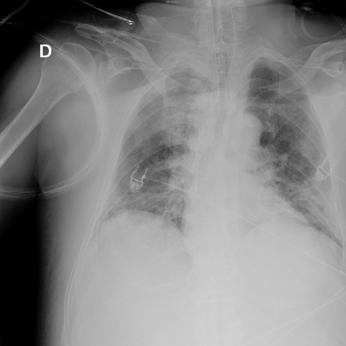 Case 40. 76yo male. Dyspnea, cough and fever. Day 1, 2, 3 and 5.