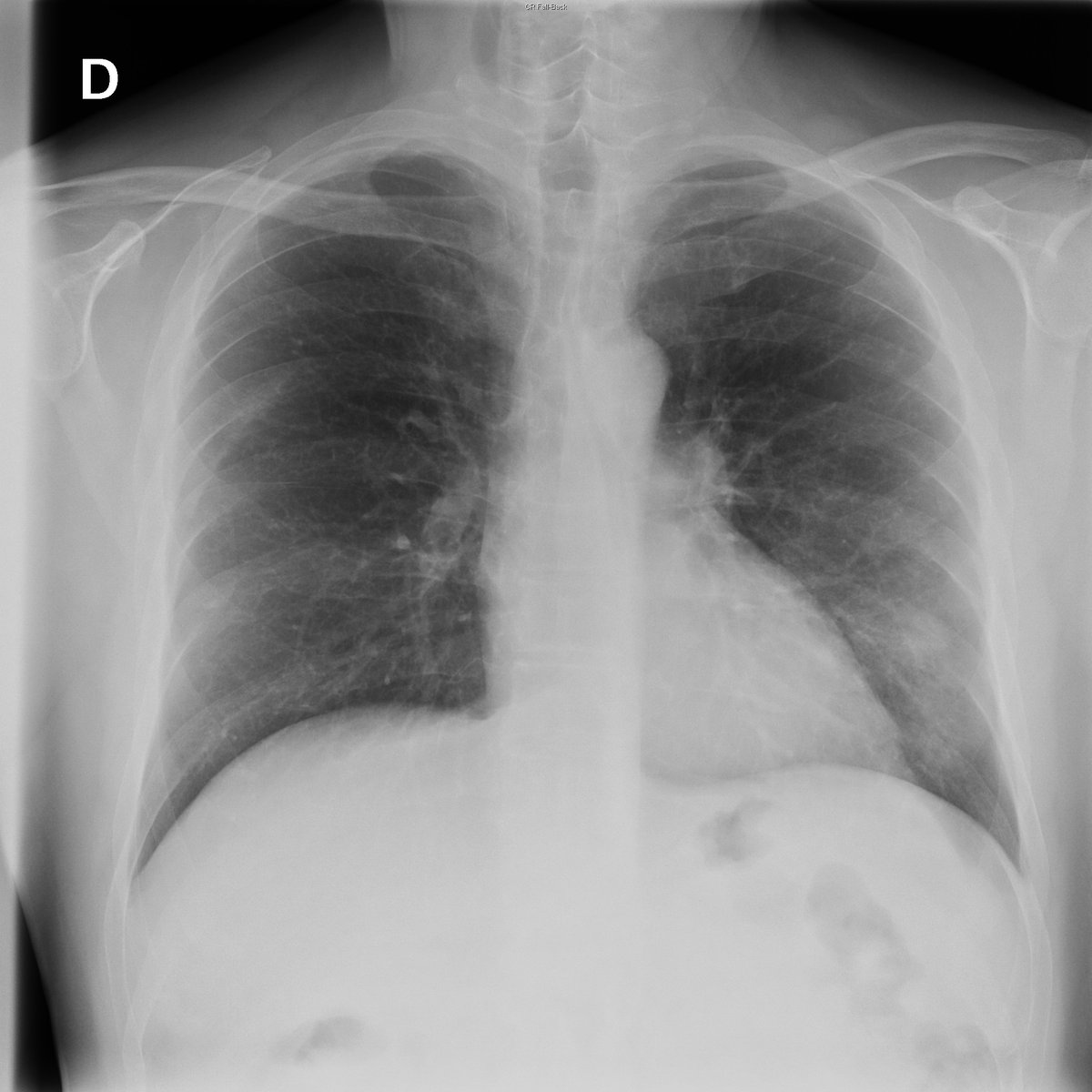 Case 37. 59yo male. Cough.