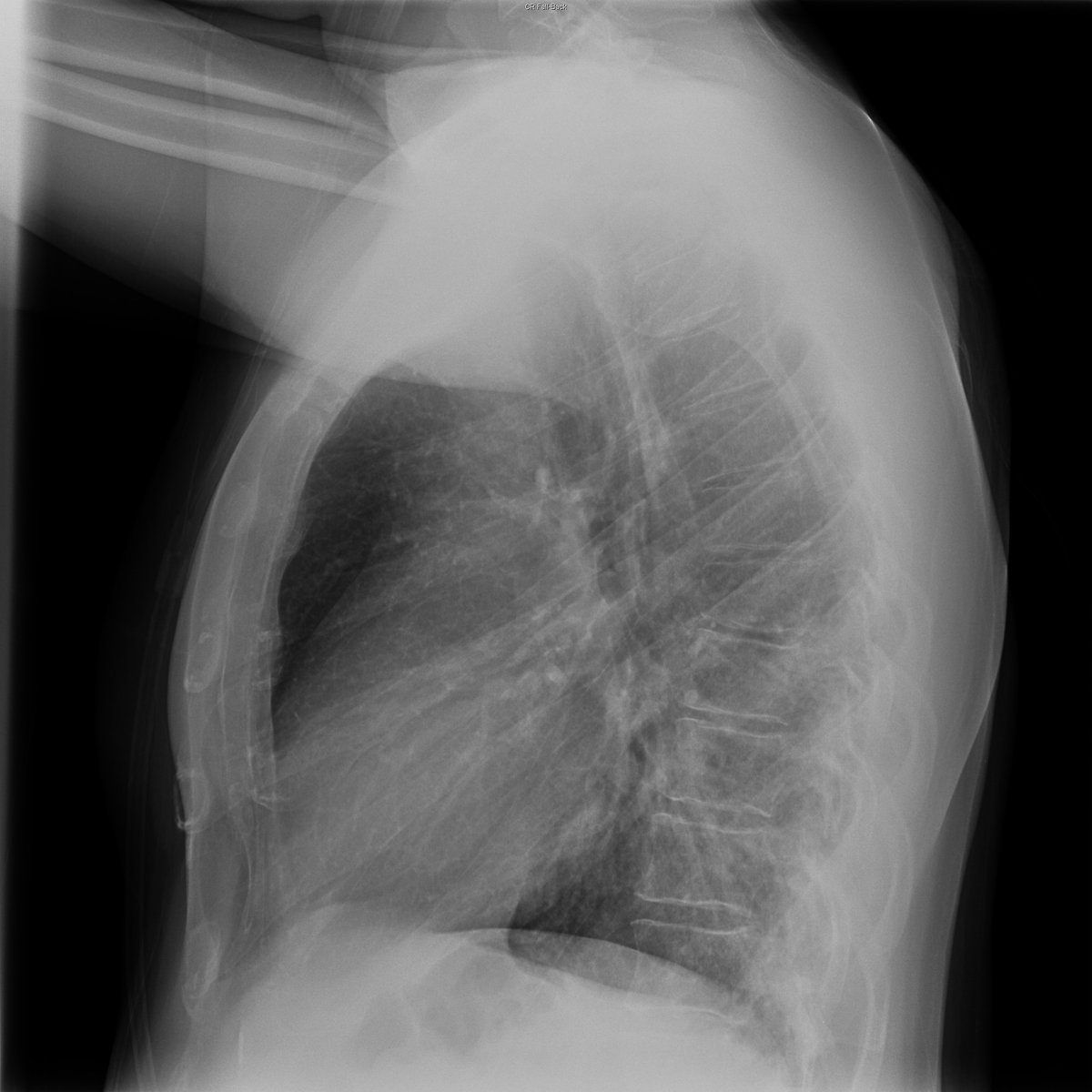 Case 39. 41yo male. Cough and fever. Day 1 (PA-L), 3 and 4.