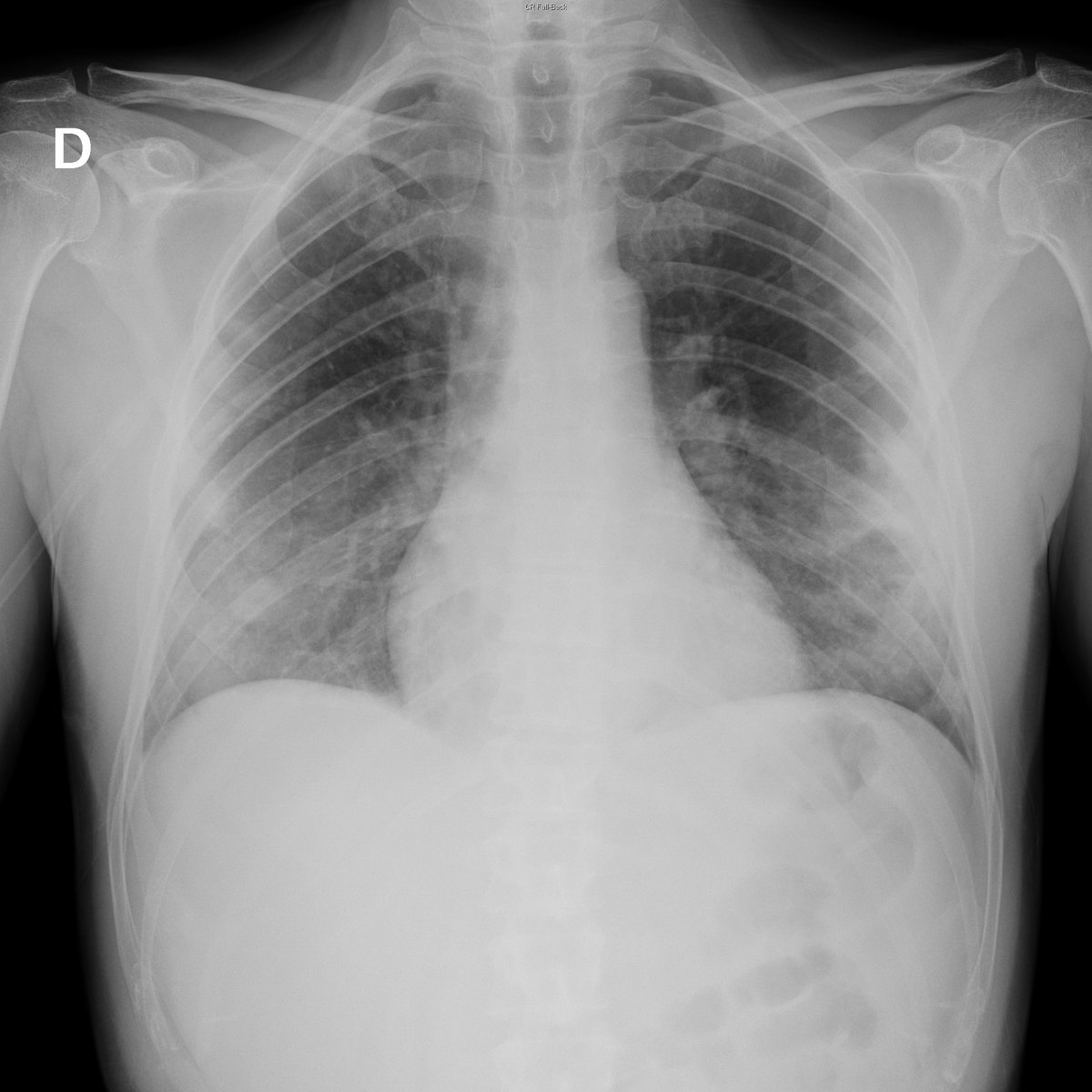 Case 39. 41yo male. Cough and fever. Day 1 (PA-L), 3 and 4.