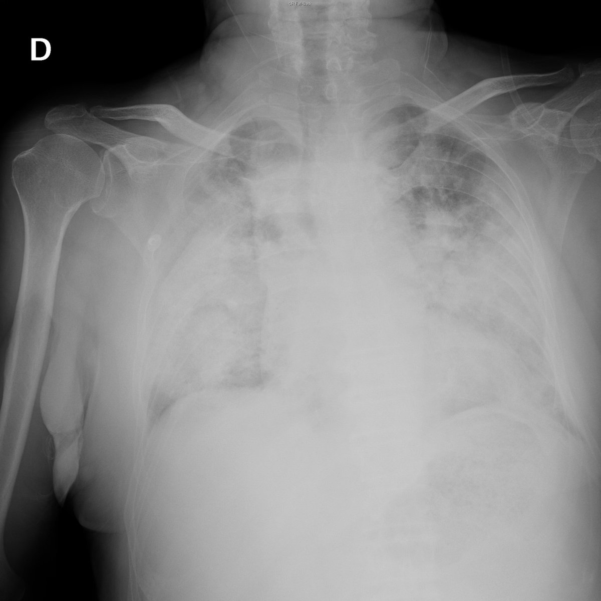 Case 41. 83yo male. SOB.