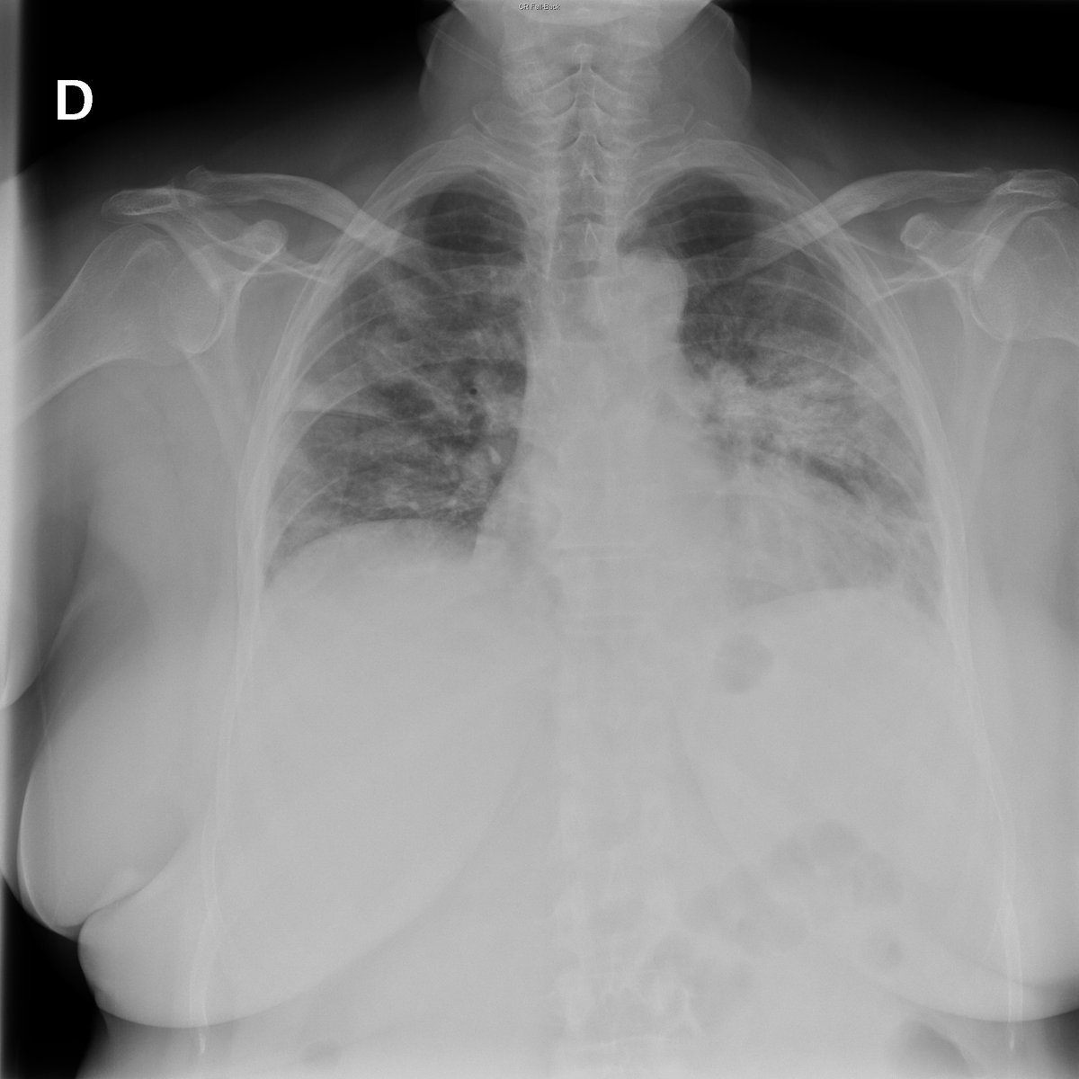 Case 43. 64yo female.