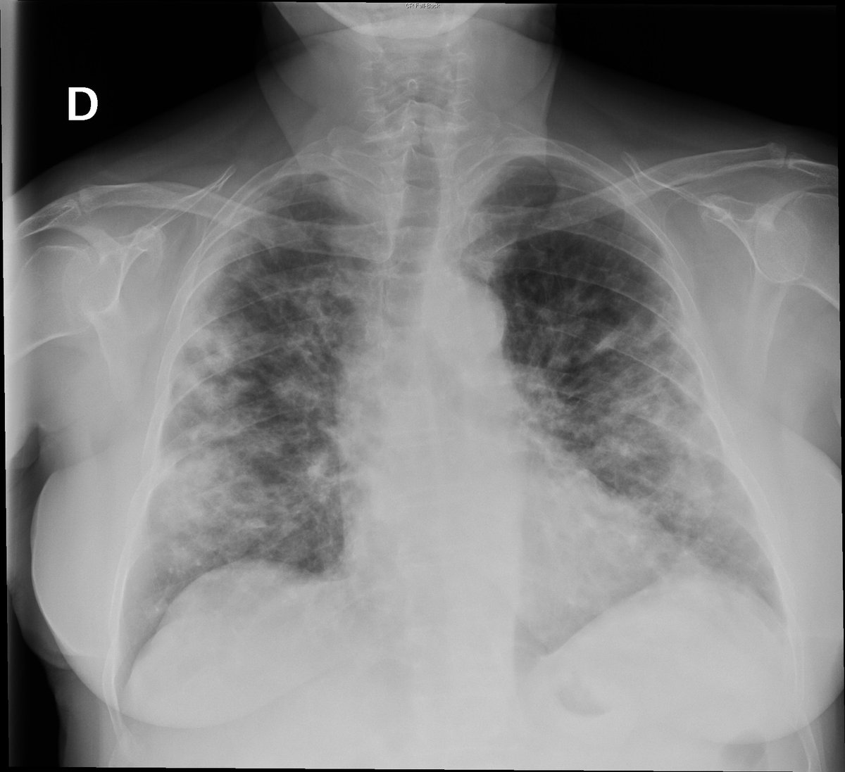 Case 44. 62yo female. Dyspnea.