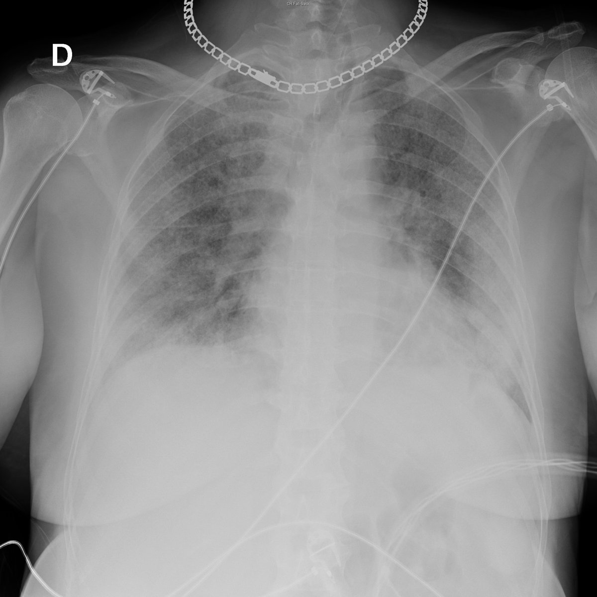 Case 45. 58yo female. Fever. Day 1 and 2.