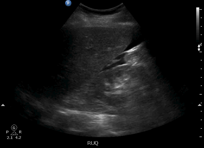Older patient with abdominal/back pain with hypotension? What could cause findings seen in Perihepatic window? Differential? #POCUS #IMPOCUS #FOAMed #FOAMus #FOAMcc <a href="/MetroHealth_EM/">MH/CCF/CWRU Emergency Medicine Residency</a> <a href="/medpedshosp/">Med Peds Hospitalist</a> <a href="/grepmeded/">GrepMed</a> <a href="/NephroP/">NephroPOCUS</a> <a href="/siddharth_dugar/">Siddharth Dugar MD FCCM,FCCM,FASE</a> <a href="/msiuba/">Matt Siuba</a>