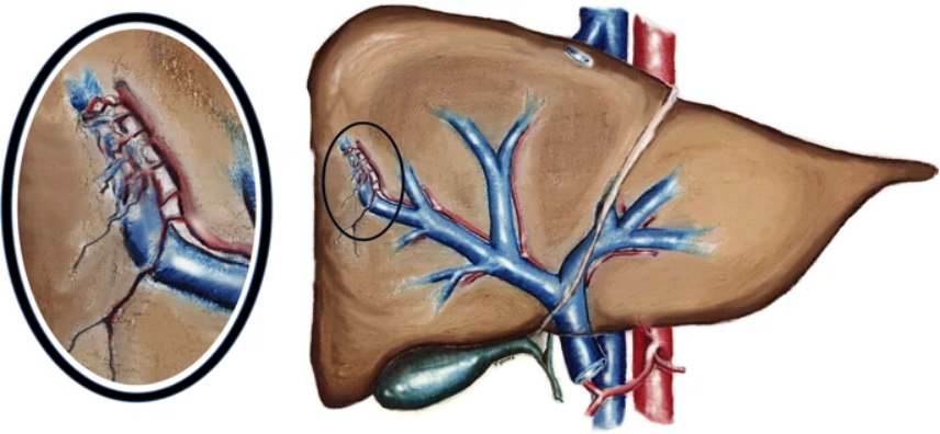 CVIR Journal (@cvir_journal) on Twitter photo Endovascular Management of Acquired Hepatic Arterial–Portal Venous Malformations | link.springer.com/article/10.100… #irad <a href="/VYoungMD/">Victoria Young</a> <a href="/NorthwesternIR/">NorthwesternIR</a> <a href="/AhsunR/">Ahsun Riaz</a> <a href="/vogelzang252/">Bob Vogelzang</a> <a href="/LewandowskiY90/">The big lewandowski</a> <a href="/riadsalemIR/">Riad Salem</a> Endovascular Management of Acquired Hepatic Arterial–Portal Venous Malformations | link.springer.com/article/10.100… #irad <a href="/VYoungMD/">Victoria Young</a> <a href="/NorthwesternIR/">NorthwesternIR</a> <a href="/AhsunR/">Ahsun Riaz</a> <a href="/vogelzang252/">Bob Vogelzang</a> <a href="/LewandowskiY90/">The big lewandowski</a> <a href="/riadsalemIR/">Riad Salem</a>