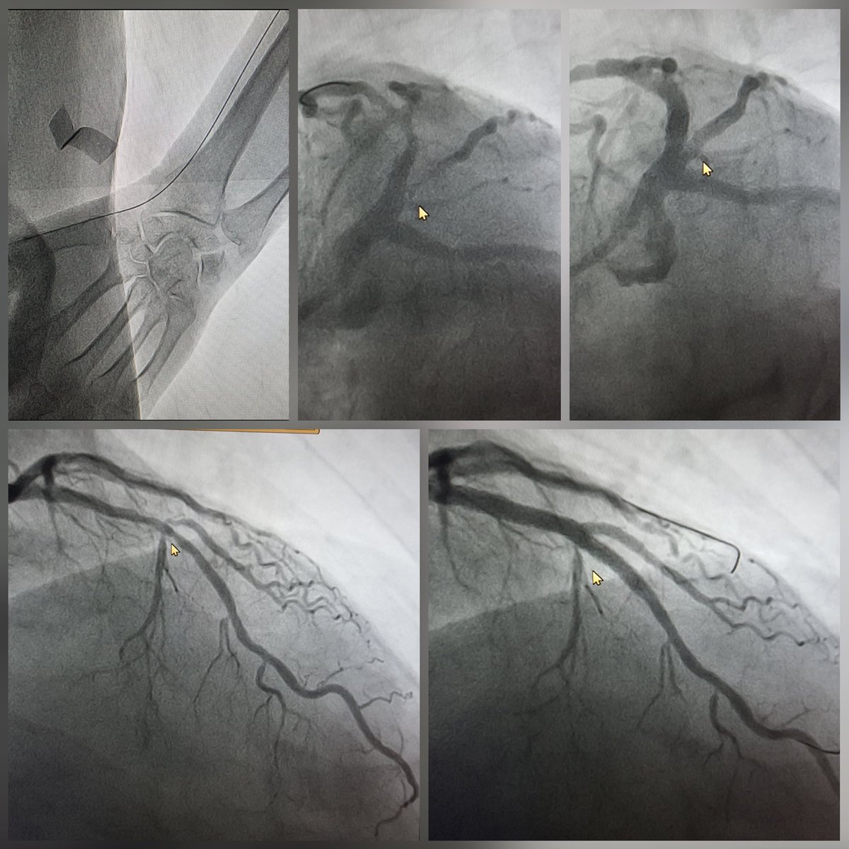mornei2011's tweet photo. 👨🏾63y, Angina, Stress test positive, #ldTRA #Radialfirst #Minicrushtechnique 2.5x16, 3.5x38 and 2.75x20 #Opticross IVUS #Synergy #Mexico 🇲🇽 @angna_86 https://t.co/dVpSzX1msb