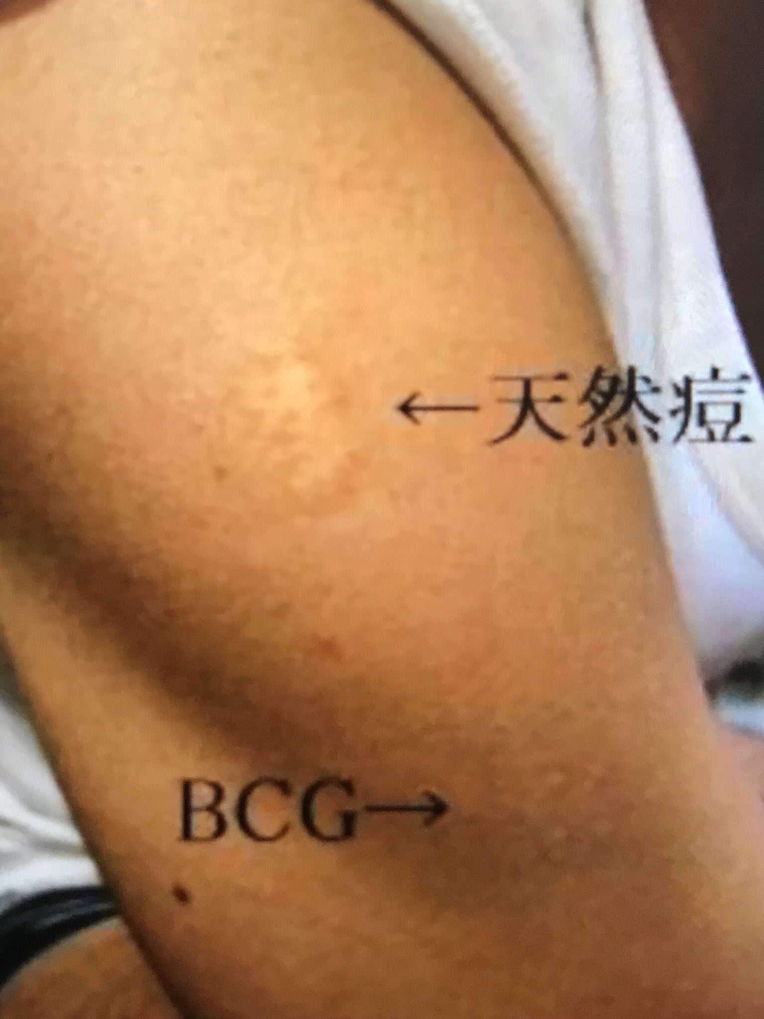 桑満おさむ gと種痘を混乱している人 やはりいるようですね かなり昔はbcgでも種痘のような痕が残っていたので ハンコ状の注射器を使用するようになったのですが 個人差はあるようですが これも残る人は残りますね Twitter
