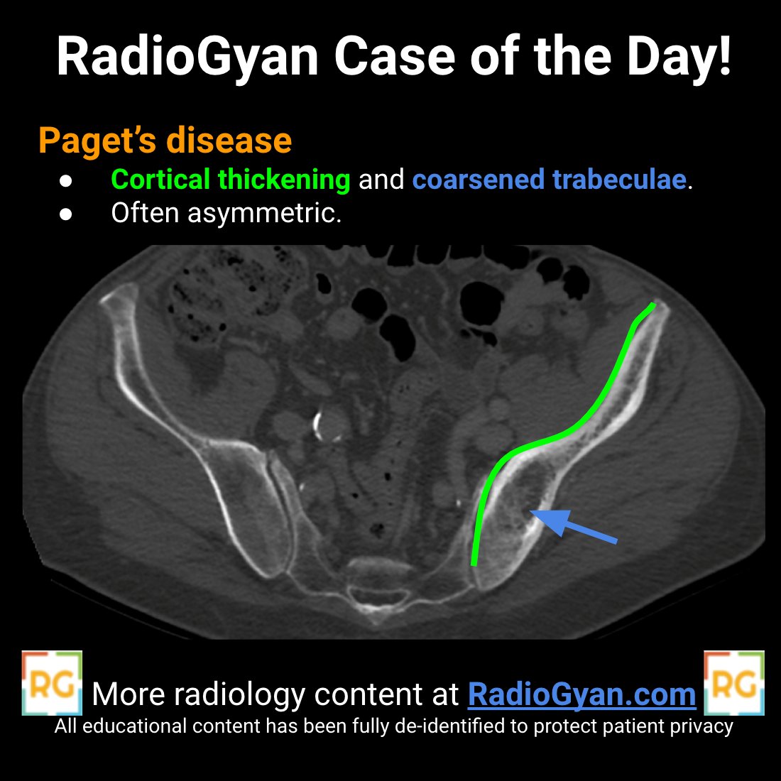 RadioGyan's tweet photo. Answer to #RGCOD 28
🎯 Paget's disease.
Trivia: Which famous personality from the 18th century was postulated to have Paget's disease?
More radiology cases at https://t.co/djrPObgbs5
#radres #FOAMrad #radcases #radtwitter #mskrad https://t.co/kEJgMsd7pb