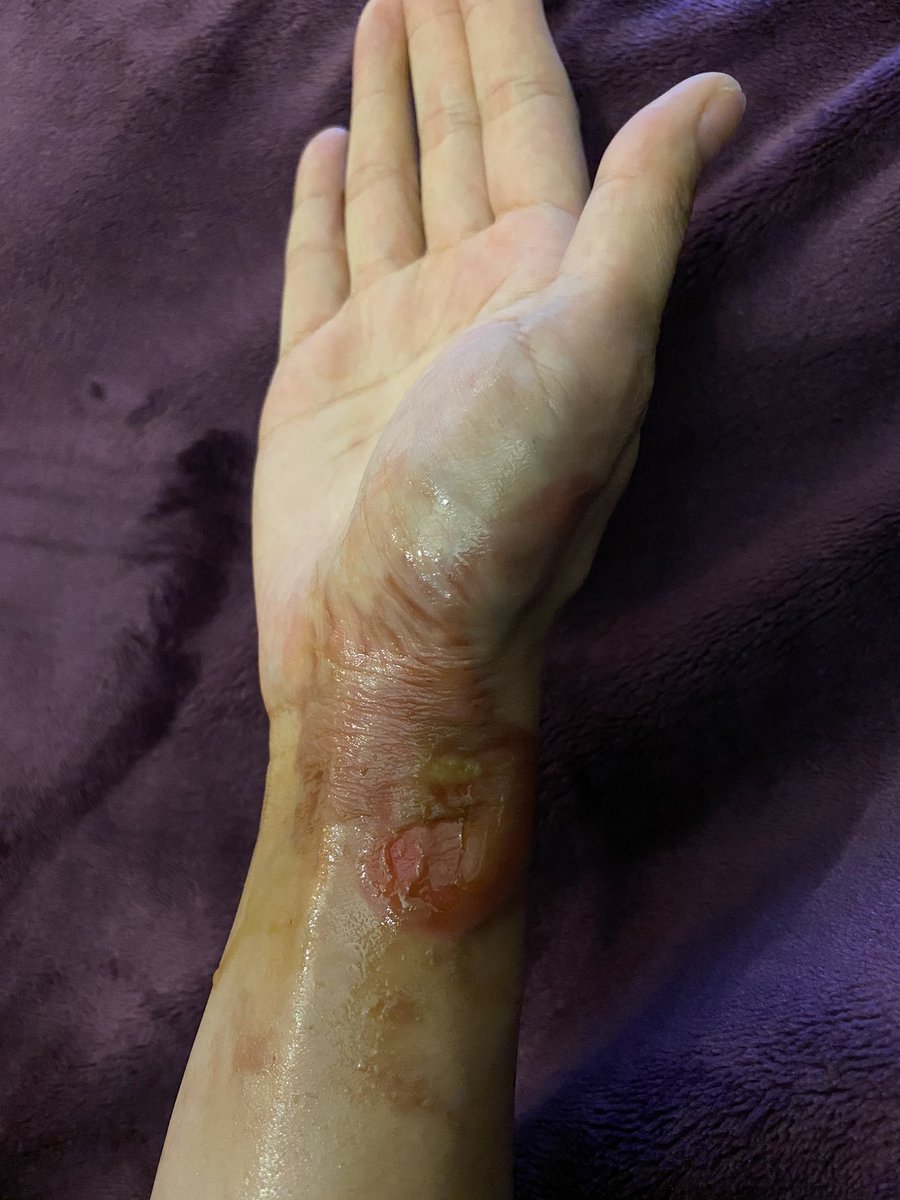 missfazura's tweet photo. Bagi yang penuh kasih-sayang serta prihatin tanya pasal keadaan tangan Faz, ni gambar terkini. Slowly recovering. InsyaAllah tak lama lagi sembuh ni. Mudah-mudahan.. Amin! Terima kasih sebab selalu tanya khabar dan doakan Faz. 🤲🏻💖 https://t.co/FOKMZTmT0G