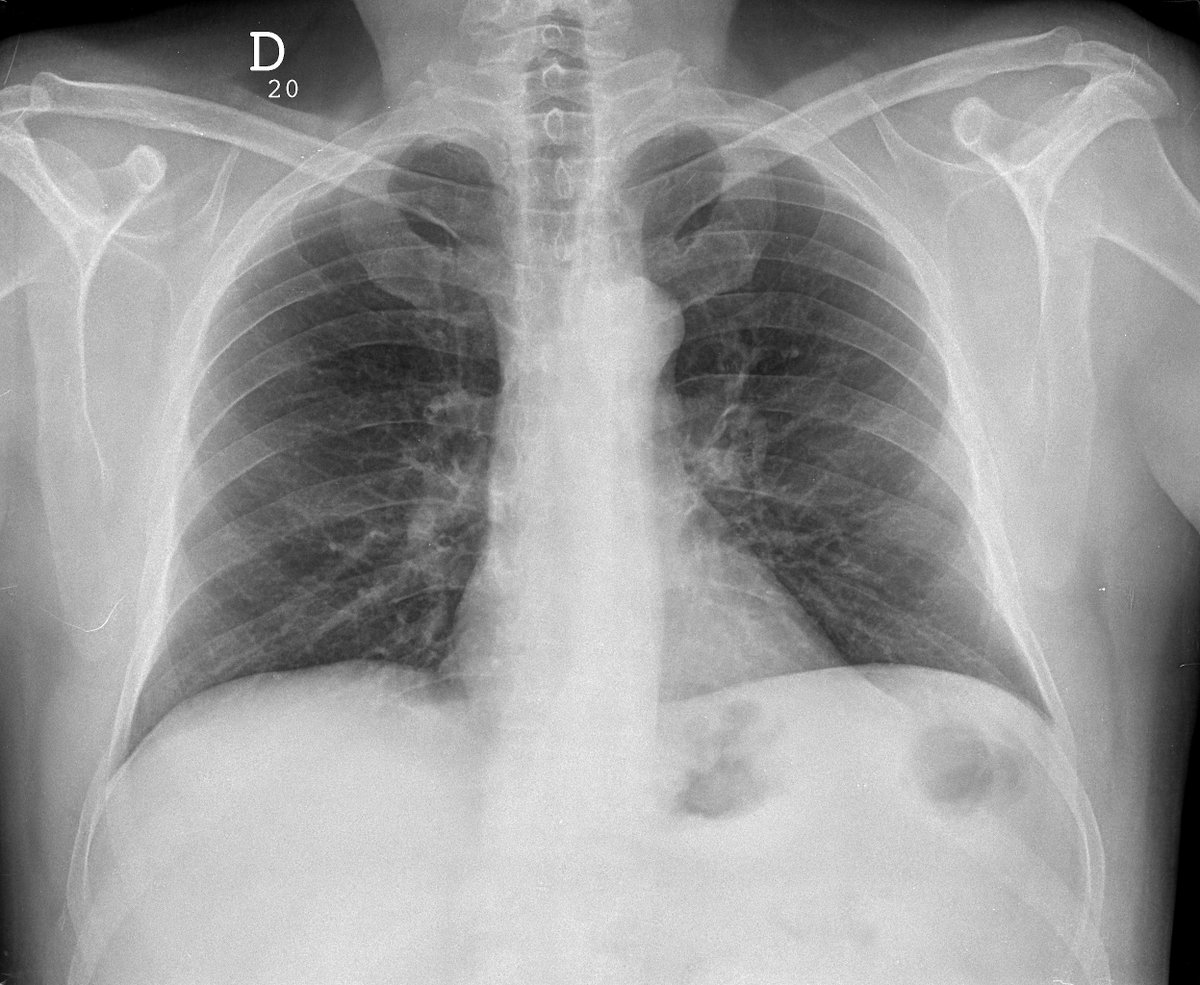 Case 49. 66yo male. Cough and fever. Previous normal CXR (year 2005) and actual. Evident opacity in the left middle lung field and subtle in LLL and RUP.