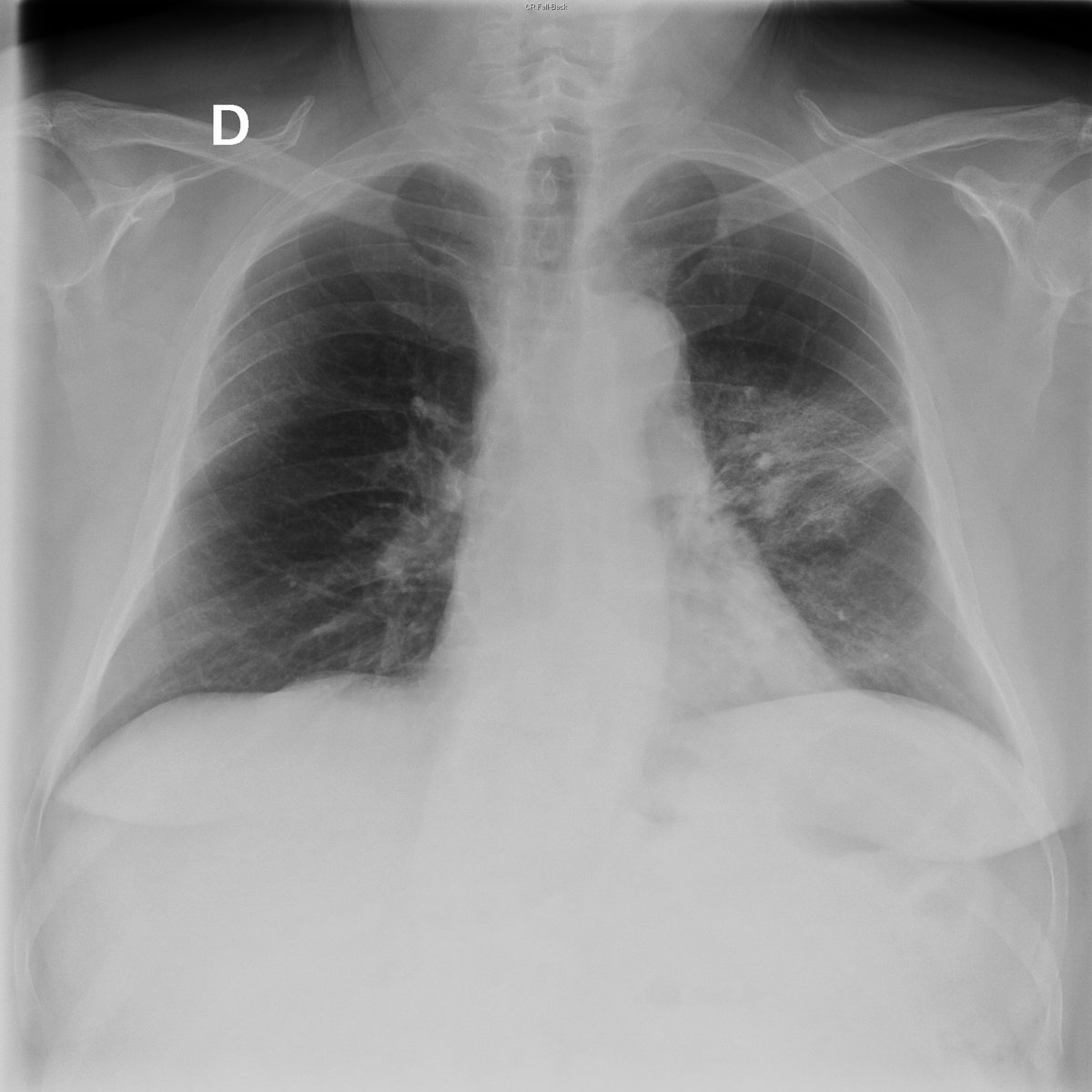 Case 49. 66yo male. Cough and fever. Previous normal CXR (year 2005) and actual. Evident opacity in the left middle lung field and subtle in LLL and RUP.