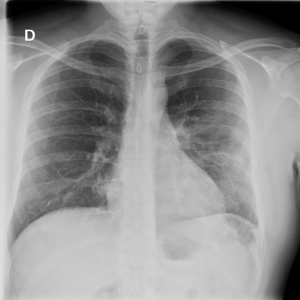 Case 50. 24yo male (youngest patient with COVID pneumonia at my institution so far). Cough and fever. Day 1 and 4. Subtle left lung opacities with progresion towards extensive consolidation.