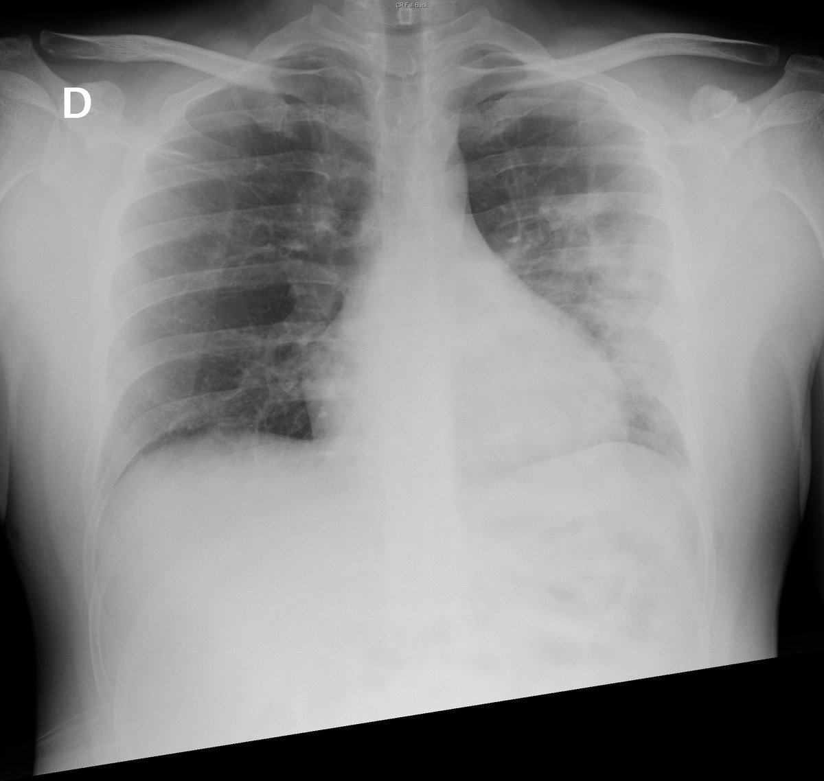 Case 50. 24yo male (youngest patient with COVID pneumonia at my institution so far). Cough and fever. Day 1 and 4. Subtle left lung opacities with progresion towards extensive consolidation.