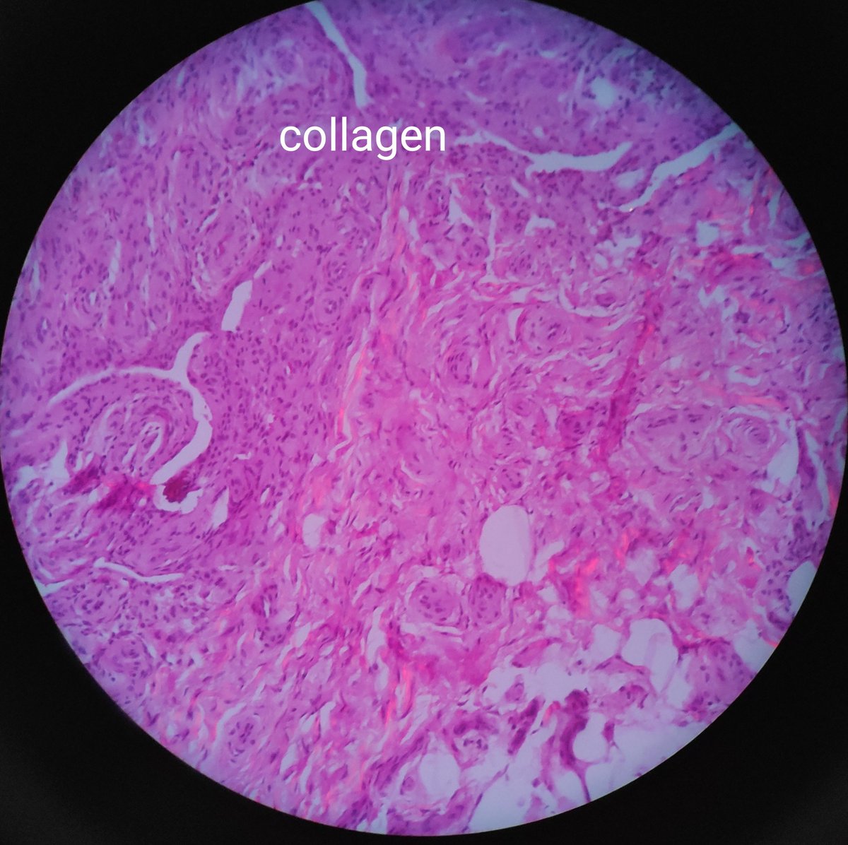 padmapathology1's tweet image. While trying to look for birefringence in CPPD crystals, I came across other types of birefringence by different tissues. Some images ⬇️ #pathology #BSTpath #birefringence #BeautyInBenign