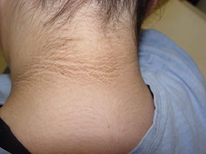 مساء الخير بنات♥️
فى واحدة كانت سألتني عن كريم تفتيح للجلد
ولما سألتها عن المنطقه المقصوده كانت زي الل فى الصوره 👇
بعد ما شوفت الحالة طلع عدها acanthosis nigricans
بعد قياس السكر طلع 356
وطلبت منها تحليل غازات الدم ABG وطلع أقل 7.35 PH
وده المتوقع ان السكر عندها يبقى عالى..!!