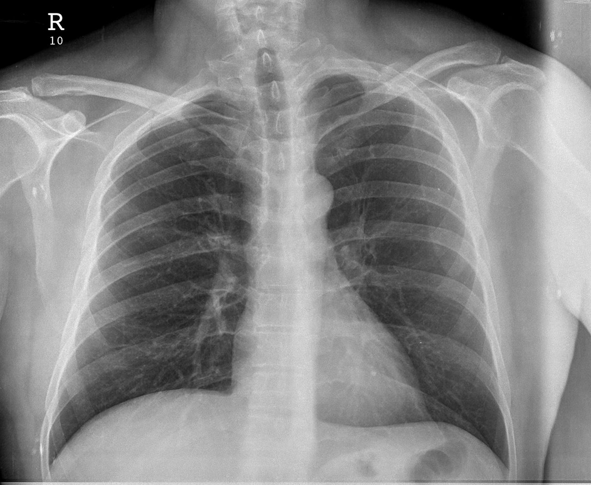 Case 46. 56yo male. Cough and fever. Previous CXR (normal; 2018), day 1 and day 5 (peripheral opacities with left predominance; progression towards extensive consolidation).