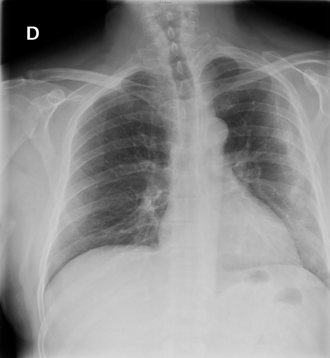 Case 46. 56yo male. Cough and fever. Previous CXR (normal; 2018), day 1 and day 5 (peripheral opacities with left predominance; progression towards extensive consolidation).