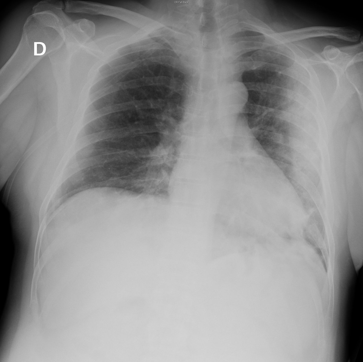 Case 46. 56yo male. Cough and fever. Previous CXR (normal; 2018), day 1 and day 5 (peripheral opacities with left predominance; progression towards extensive consolidation).