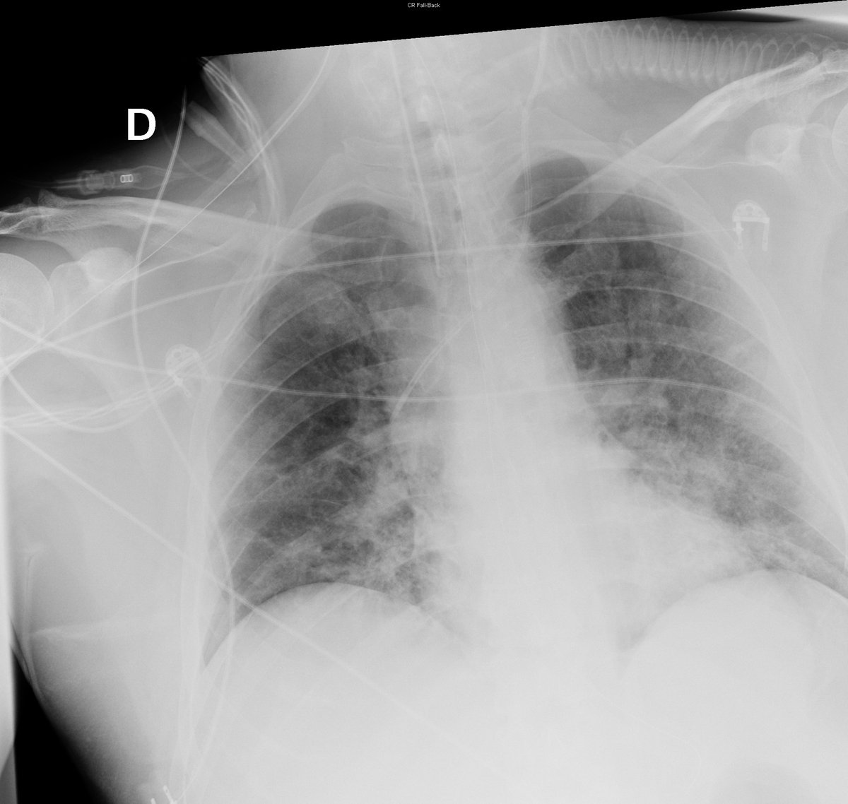 Case 47. 54yo male. Cough and fever. Day 1, 5 (acute respiratory failure), 7 and 9. Small peripheral opacities with progresion toward extensive bilateral consolidation.