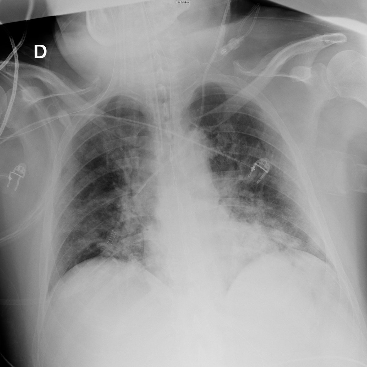 Case 47. 54yo male. Cough and fever. Day 1, 5 (acute respiratory failure), 7 and 9. Small peripheral opacities with progresion toward extensive bilateral consolidation.