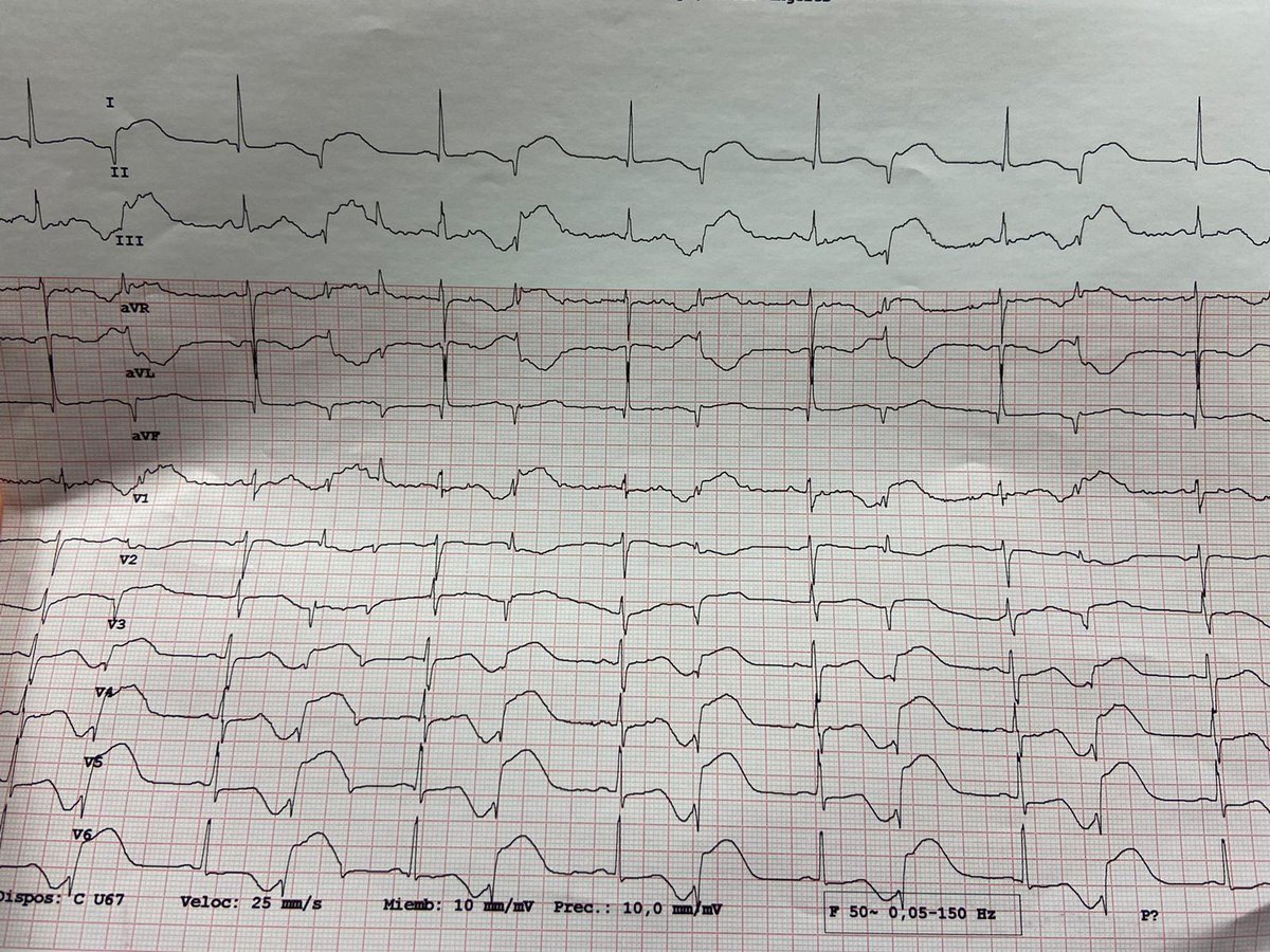 Luis Nieto (@luisnietor93) on Twitter photo Por esto hay que hacer un ECG si damos Hidroxicloroquina + azitromicina!!!
This is why an EKG is needed when prescribing hidroxicloroquine + azithromycin #COVID19 <a href="/Hospital_FJD/">Fundación Jiménez Díaz</a> <a href="/secardiologia/">Soc Esp Cardiología</a> <a href="/escardio/">European Society of Cardiology</a> Por esto hay que hacer un ECG si damos Hidroxicloroquina + azitromicina!!!
This is why an EKG is needed when prescribing hidroxicloroquine + azithromycin #COVID19 <a href="/Hospital_FJD/">Fundación Jiménez Díaz</a> <a href="/secardiologia/">Soc Esp Cardiología</a> <a href="/escardio/">European Society of Cardiology</a>