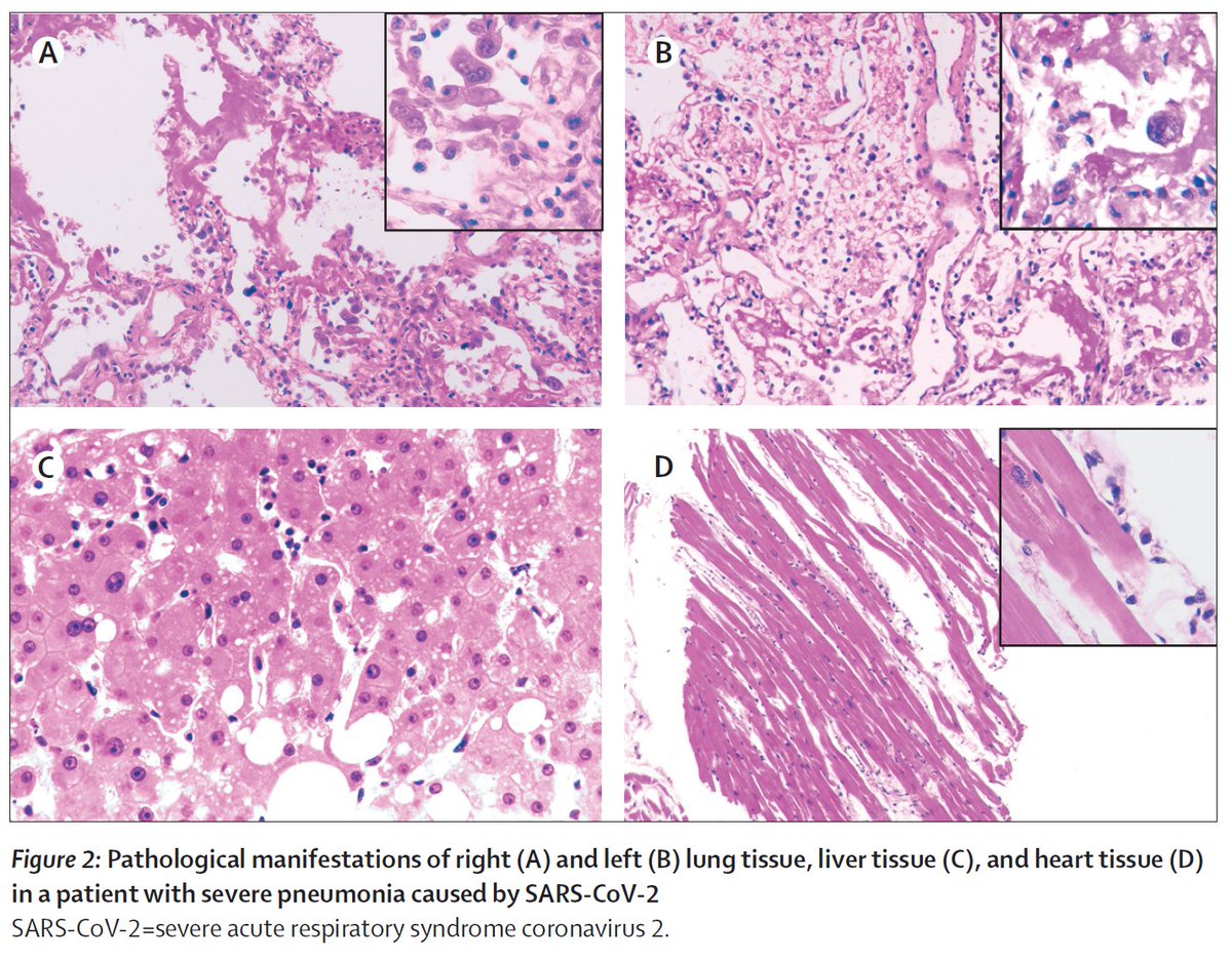 Are T-cells being 'consumed' at the site of disease? Histopath of COVID19 lung shows lymphocyte infiltration -  https://www.thelancet.com/journals/lancet/article/PIIS2213-2600(20)30076-X/fulltext. scSeq of BAL cells found clonally expanded CD8s in mild  #COVID19 & proliferating T-cells in severe cases -  https://doi.org/10.1101/2020.02.23.20026690 8/12