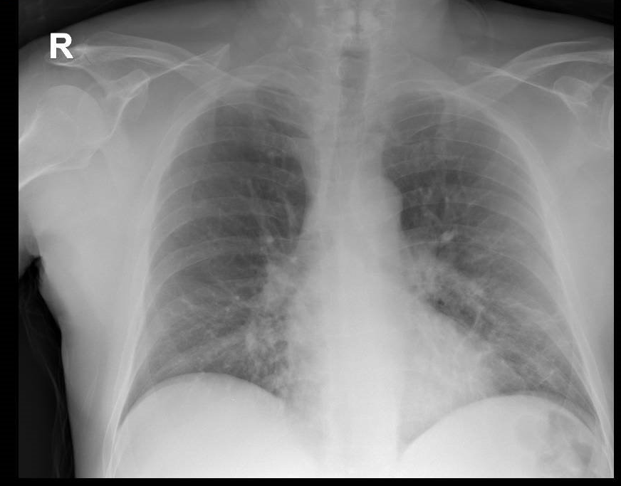 julymed08's tweet photo. Varón de 45a sano.
Disnea y tos seca de 2 días de evolución. Fiebre 38º.
Rx 1: 2do día. Rx 2: 5to día.
Elevación ferritina, PCr y LDH desde inicio del cuadro.
SpO2: 89% 15l/min
IOT reglada precoz.
Dolquine/Azitro previa
Tolicizumab dosis puesta.
Así es el #Covid_19 https://t.co/0GQzuySGYa