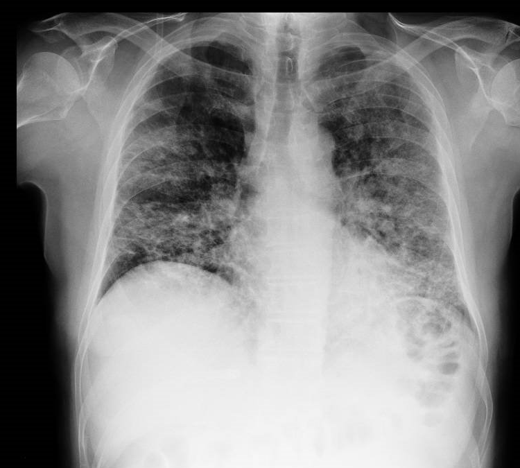 julymed08's tweet photo. Varón de 45a sano.
Disnea y tos seca de 2 días de evolución. Fiebre 38º.
Rx 1: 2do día. Rx 2: 5to día.
Elevación ferritina, PCr y LDH desde inicio del cuadro.
SpO2: 89% 15l/min
IOT reglada precoz.
Dolquine/Azitro previa
Tolicizumab dosis puesta.
Así es el #Covid_19 https://t.co/0GQzuySGYa