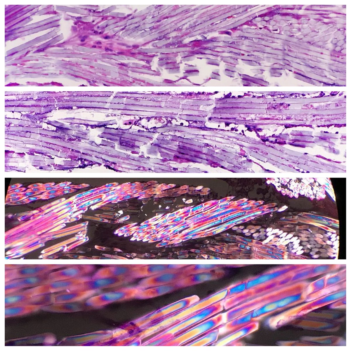 yro854's tweet photo. These images of braided suture material contributed by @JMGardnerMD are some of many that have recently been added to the Atlas of Medical Foreign Bodies (https://t.co/fmeZ5acgla bodies. More to come. Please email image contributions to frbodies@gmail.com.
#foreignbodies #pathart https://t.co/6IcgPsBZyp