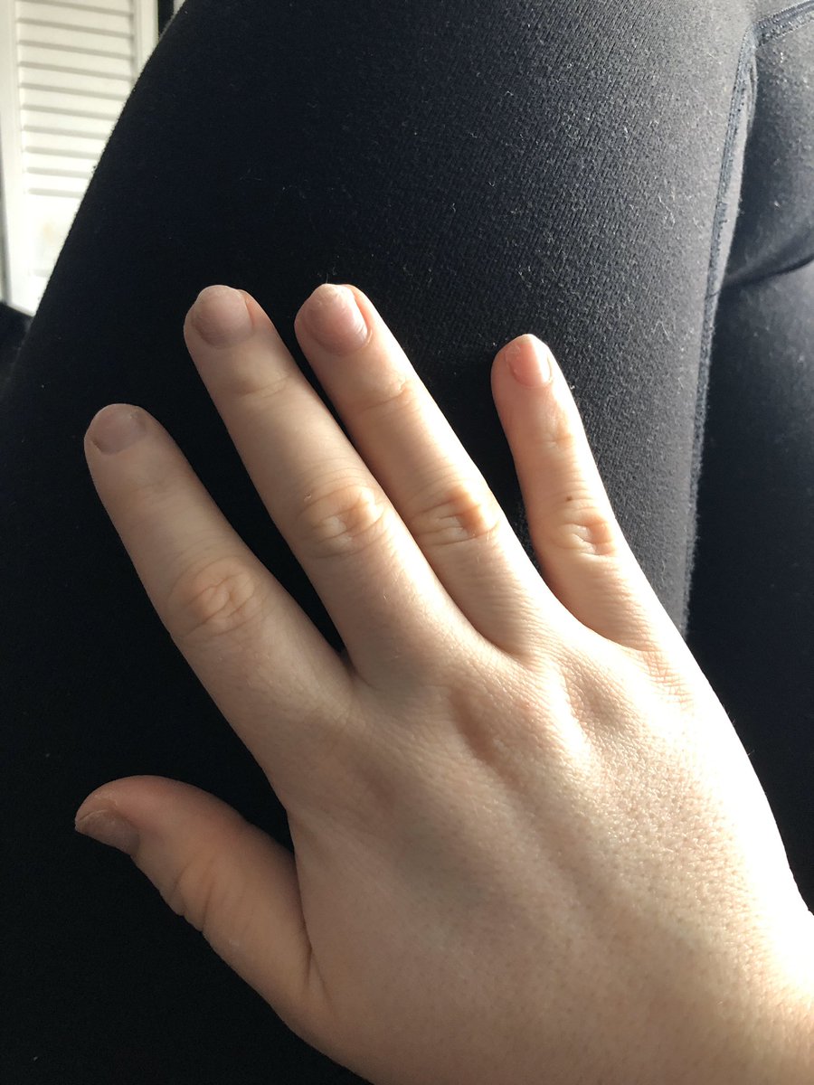 Danielle__Adams's tweet photo. @chelsleebarron I wanna puke at my baby hands https://t.co/X5VhgTNvJV