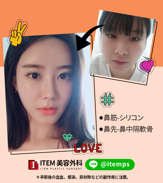 itemjp's tweet photo. ♡症例写真♡

鼻整形が有名な病院、アイテム美容外科では
自然な鼻整形を好まれる方たちにたくさん来院していただいております 👃❤

LINE ID▶️ @itemps
クリックで追加▶️https://t.co/OcUGiEvHmy

#韓国整形 #鼻整形　#鼻の整形 #美容整形 https://t.co/pey5OLwxRL