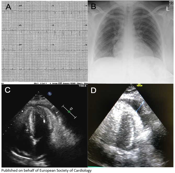 Life-threatening case of #COVID19 associated cardiac tamponade bit.ly/2UZjJmb

 #EHJ <a href="/ehj_ed/">EHJ Editor-in-Chief</a> #cardiotwitter #pericarditis #COVIDー19