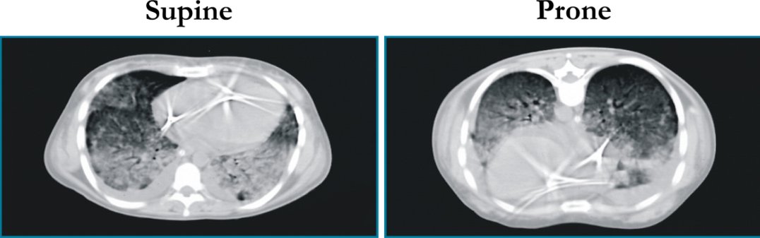 1/21 After caring for patients in the ICU with #COVID for the last week, the time seems right for a #pulmonology #tweetorial on #Proning or #PronePositioning 

@sanjayvdesai @OslerResidency @JHUPCCMFellows @CPSolvers @thecurbsiders @cardionerds @tony_breu @david_furfaro @chadhoc