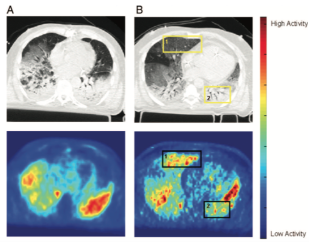 6/ First, let’s look at redistribution of blood flow. Studies in animals and humans (using PET) have shown that blood flow distribution in the lung does not change substantially from supine to prone position in ARDS.  https://www.ncbi.nlm.nih.gov/pubmed/2347780   https://www.ncbi.nlm.nih.gov/pubmed/19487931 