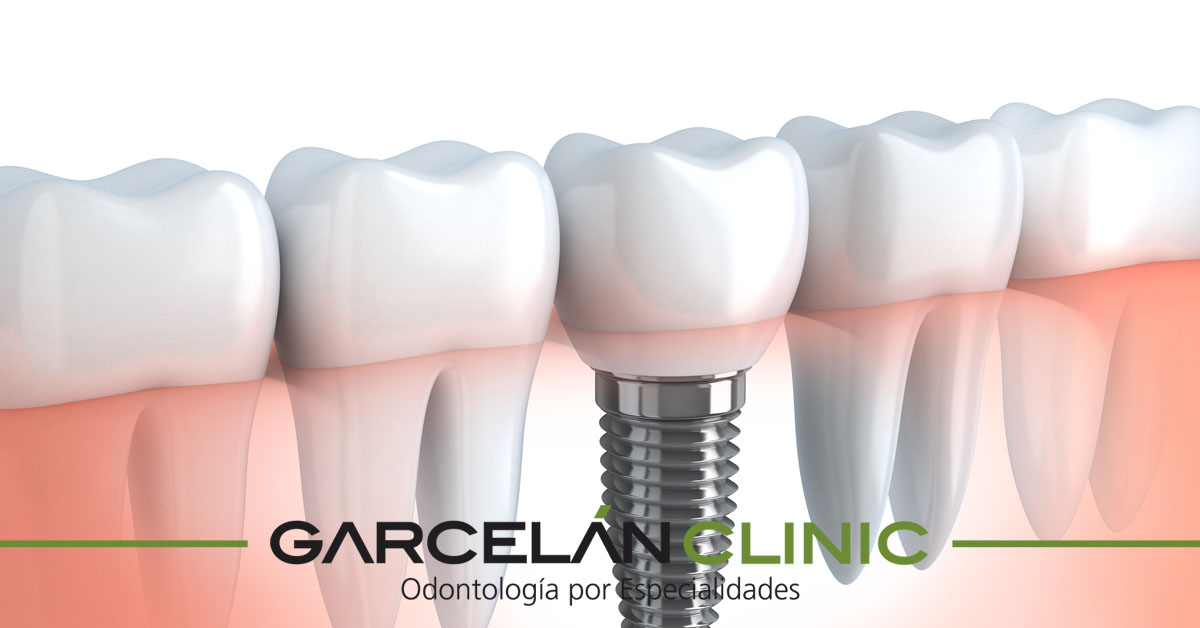 GarcelanClinic's tweet photo. ¿Tienes dudas sobre #ImplantesDentales? A ver si podemos ayudarte a despejarlas desde la sección de Preguntas Frecuentes de nuestra web: https://t.co/M3YeJlKmEF https://t.co/j8gNMKtc27