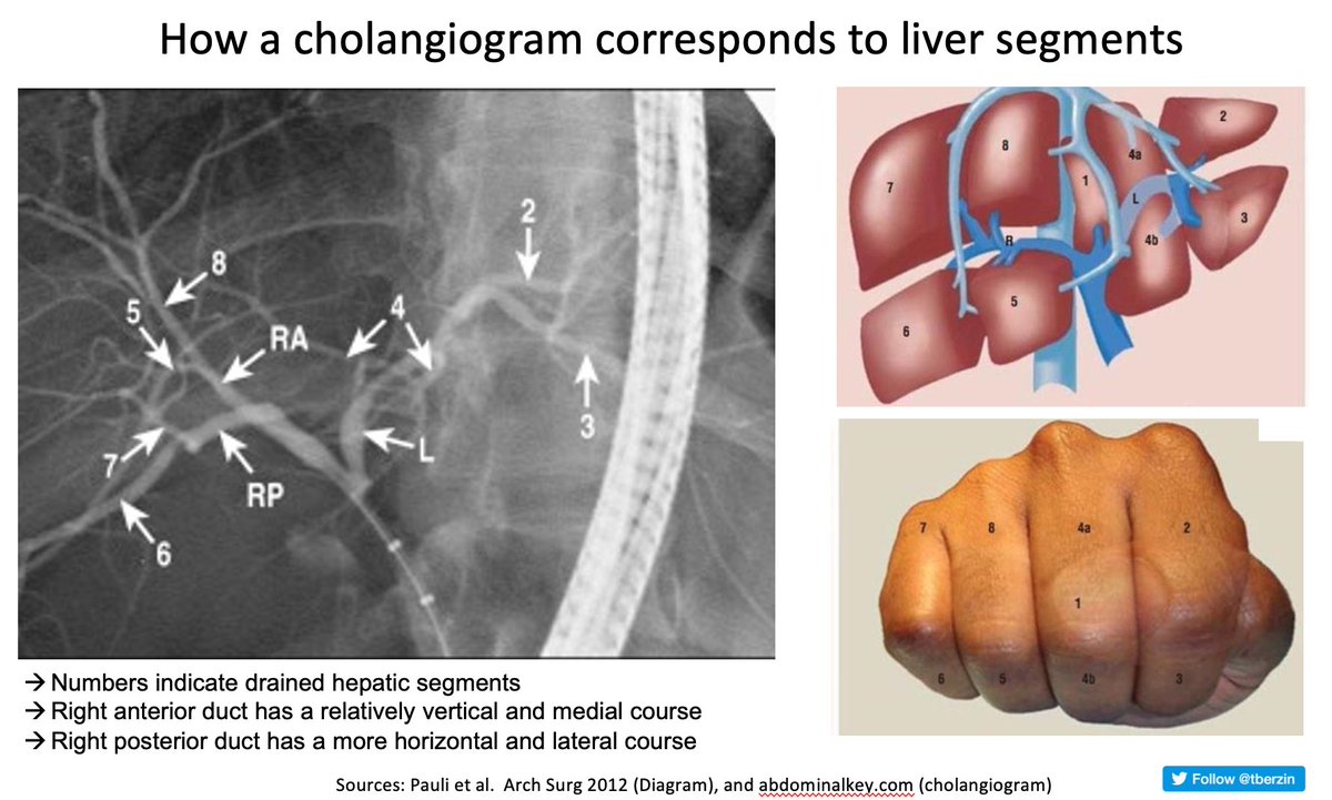 How many advanced endoscopists can correctly identify the liver segments drained on a cholangiogram? Here's some 'advanced' ERCP anatomy (featuring @ericpaulimd's famous fist). #GItwitter