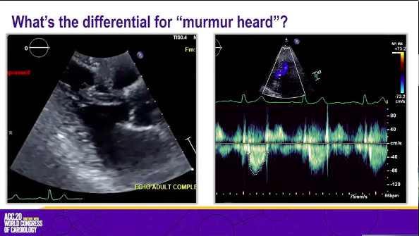 DrHilaryShapiro's tweet photo. #StumpTheProfessor Case 2 presented by @CharlieJainMD
Middle aged F with HFpEF and DOE, goes for exercise RHC showing exercise pulm HTN. https://t.co/Td8zUEv3bJ