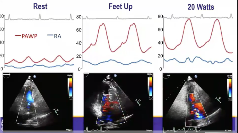 DrSFeldman's tweet photo. @CharlieJainMD of @MayoClinic presents a challenging case of dyspnea on exertion for #StumpTheProfessor #ACC20 #WCCardio https://t.co/Vvk24BzPGD